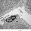 1C6A Cystinosis (Case 1) EM044 - Copy