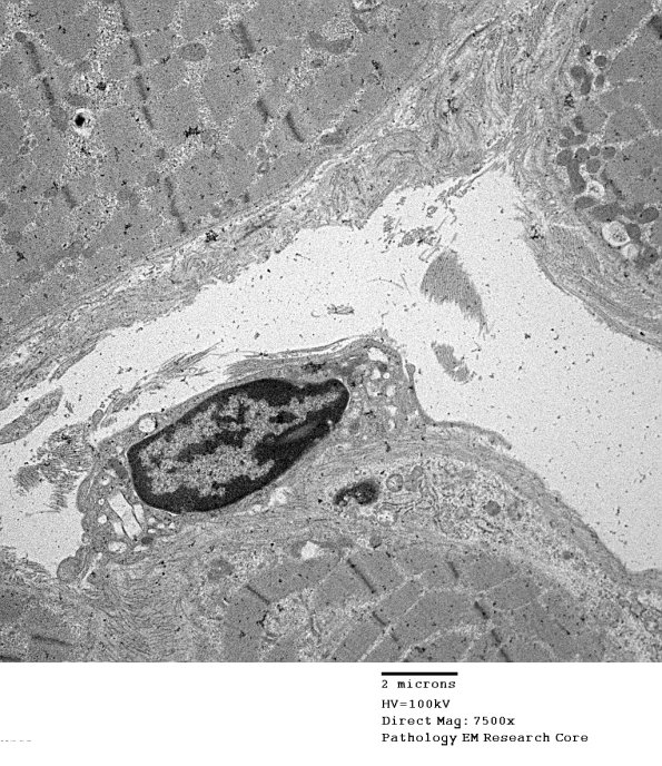1C6A Cystinosis (Case 1) EM044 - Copy