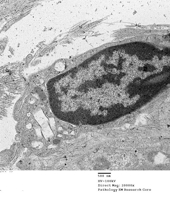 1C6B Cystinosis (Case 1) EM045 - Copy