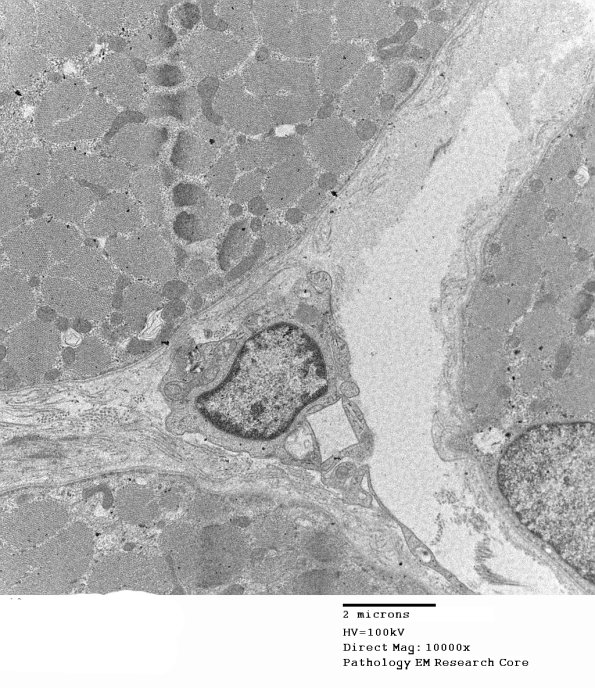 1C7A Cystinosis (Case 1) EM048 - Copy
