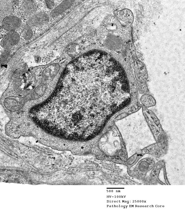 1C7B Cystinosis (Case 1) EM049 - Copy