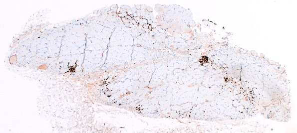 1C1 Dermatomyositis (Case 1) CD3 4X