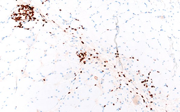 1C2 Dermatomyositis (Case 1) CD3 20X 1
