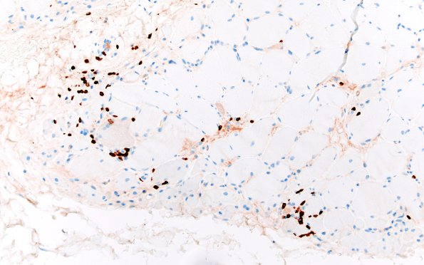 1C3 Dermatomyositis (Case 1) CD3 20X 2