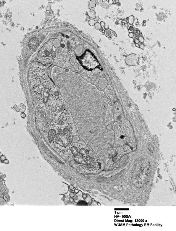 1I3 Case 1  024 - Copy