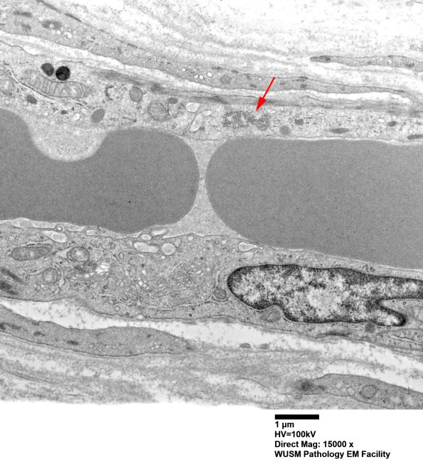 1I5A Dermatomyositis (Case 1) R Delt Muscle_010 copy - Copy