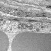 1I5B Dermatomyositis (Case 1) R Delt Muscle_011 - Copy