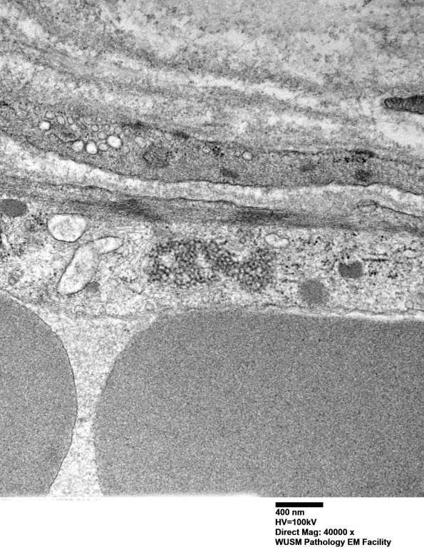 1I5B Dermatomyositis (Case 1) R Delt Muscle_011 - Copy