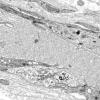 1I6A Dermatomyositis (Case 1) R Delt Muscle_012 - Copy