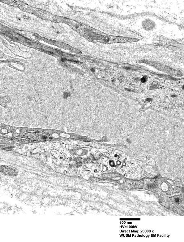 1I6A Dermatomyositis (Case 1) R Delt Muscle_012 - Copy