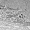 1I6B Dermatomyositis (Case 1) R Delt Muscle_013 - Copy