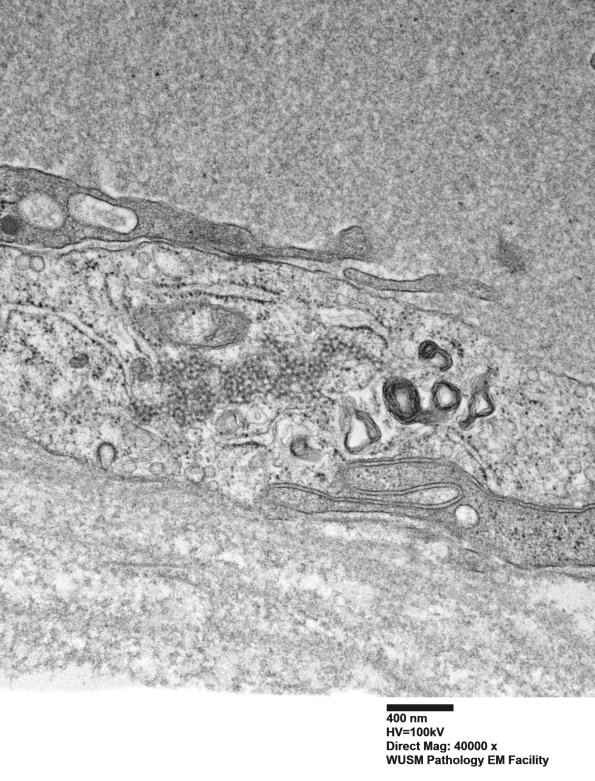 1I6B Dermatomyositis (Case 1) R Delt Muscle_013 - Copy
