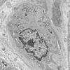 1I7A Dermatomyositis (Case 1 R Delt Muscle_020 - Copy
