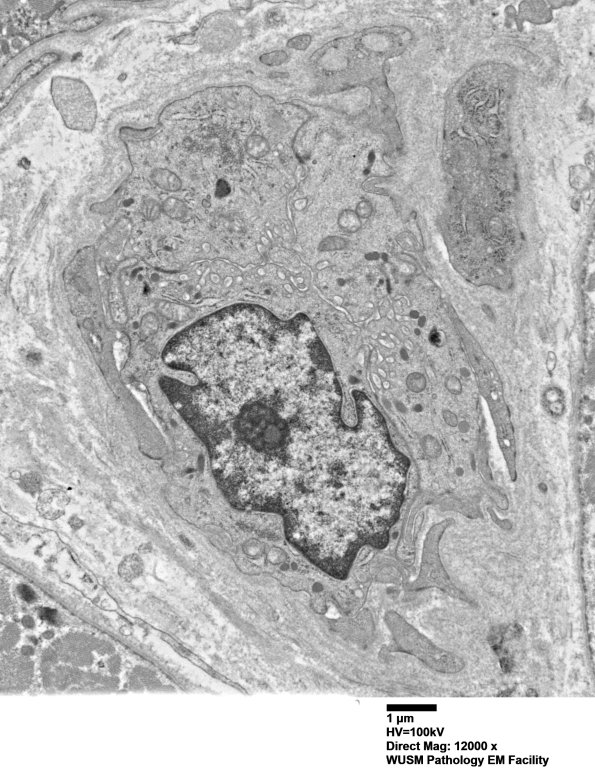 1I7A Dermatomyositis (Case 1 R Delt Muscle_020 - Copy