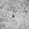 1I7B Dermatomyositis (Case 1) R Delt Muscle_021 - Copy