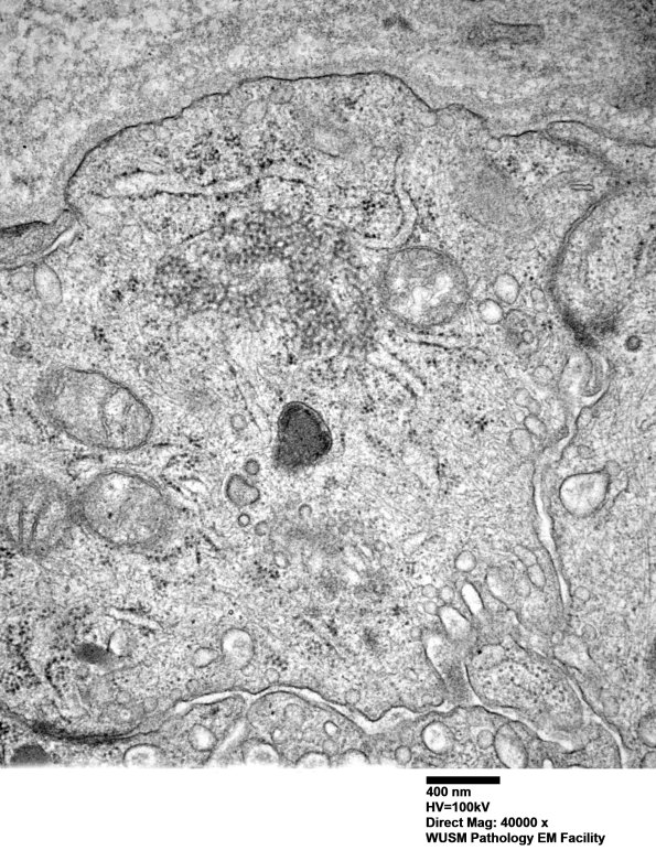 1I7B Dermatomyositis (Case 1) R Delt Muscle_021 - Copy