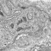 1I8B Dermatomyositis (Case 1) R Delt Muscle_026 - Copy