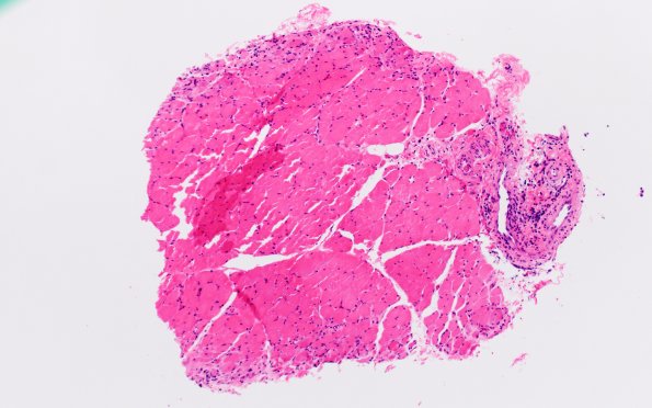 2A1Atrophy, Perifascicular (Case 2) H&E 2