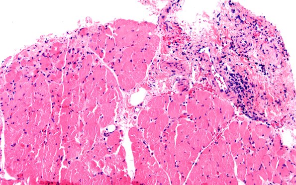 2A3 Atrophy, Perifascicular (Case 2) H&E 20X 2