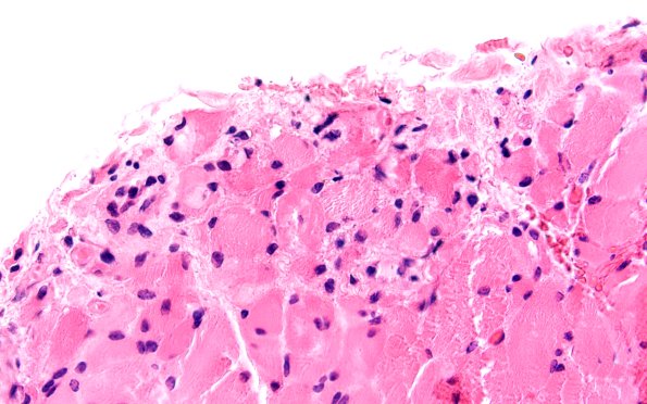 2A4 Atrophy, Perifascicular (Case 2) H&E 60X 2