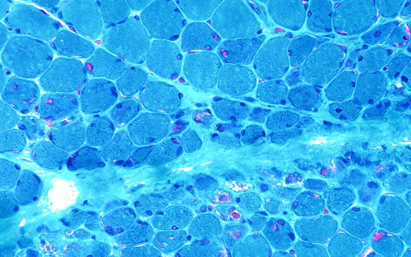2B Atrophy, Perifascicular (Case 2) Gomori 40X