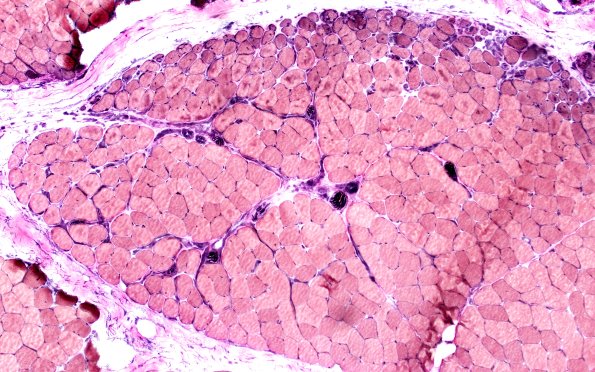 2C1 Atrophy, Perifascicular (Case 2) VVG 10X