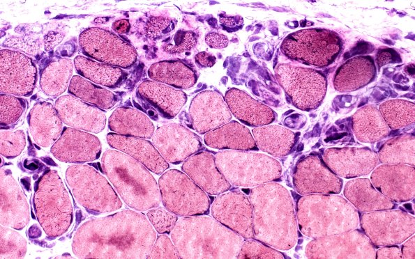 2C2 Atrophy, Perifascicular (Case 2) VVG 40X 2