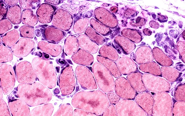 2C3 Atrophy, Perifascicular (Case 2) VVG 40X