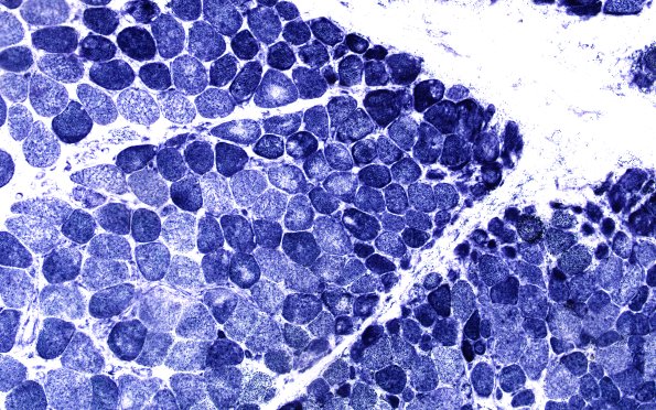 2F Atrophy, Perifascicular (Case 2) SDH 20X