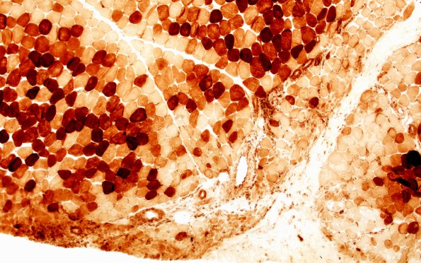 2G2 Atrophy, Perifascicular (Case 2) COX 10X