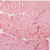 2H1 Atrophy, Perifascicular (Case 2) APase 10X 2