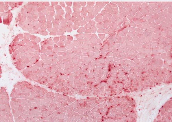 2H1 Atrophy, Perifascicular (Case 2) APase 10X 2