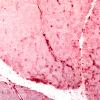 2H2 Atrophy, Perifascicular (Case 2) APase 10X