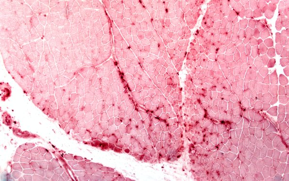 2H2 Atrophy, Perifascicular (Case 2) APase 10X