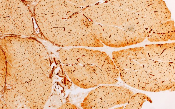 2I1 Atrophy, Perifascicular (Case 2) Ulex 4X