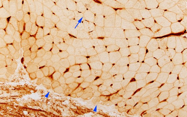 2I2 Atrophy, Perifascicular (Case 2) Ulex 20X 2 copy A