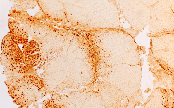 2J1 Atrophy, Perifascicular (Case 2) LC3 4X