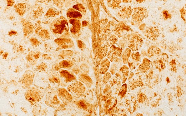 2J2 Atrophy, Perifascicular (Case 2) LC3 40X