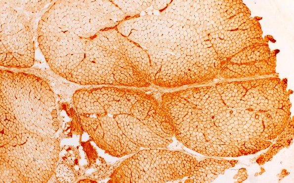 2K1 Atrophy, Perifascicular (Case 2) MHC1 4X