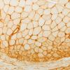 2K2 Atrophy, Perifascicular (Case 2) MHC1 20X