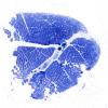 2L1 Atrophy, Perifascicular (Case 2) Plastic 7