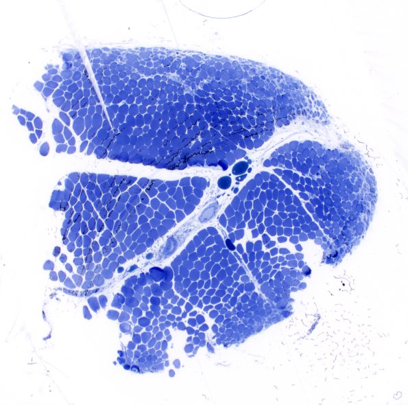 2L1 Atrophy, Perifascicular (Case 2) Plastic 7