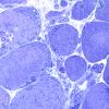 2L10 Atrophy, Perifascicular (Case 2) Plastic 100X 8