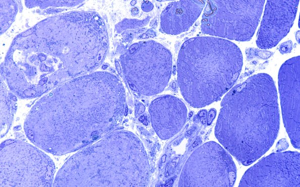 2L10 Atrophy, Perifascicular (Case 2) Plastic 100X 8