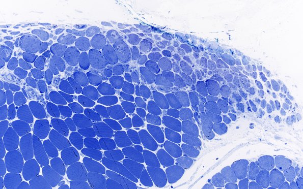 2L2 Atrophy, Perifascicular (Case 2) Plastic 4
