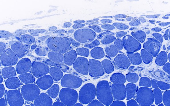 2L4 Atrophy, Perifascicular (Case 2) Plastic 10