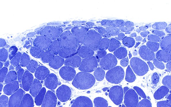 2L5 Atrophy, Perifascicular (Case 2) Plastic 1A