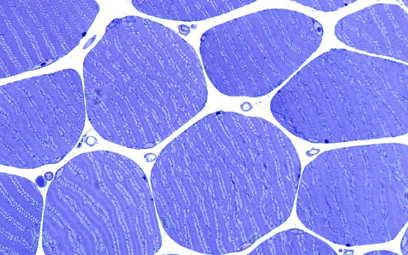2L8A Atrophy, Perifascicular (Case 2) Plastic 100X 2