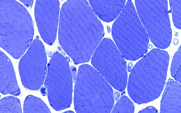 2L8B Atrophy, Perifascicular (Case 2) Plastic 100X 3