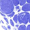2L9Atrophy, Perifascicular (Case 2) Plastic 100X 5